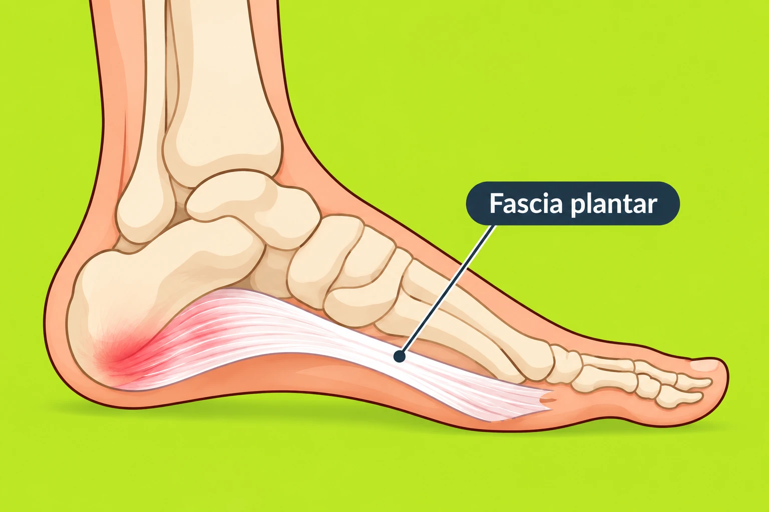 Ilustración de la fascia plantar y su recorrido desde el talón hasta los dedos